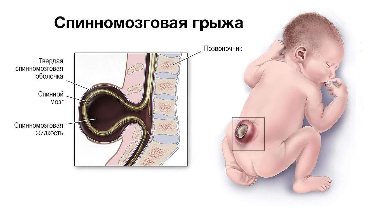 Операция на позвоночнике в утробе матери