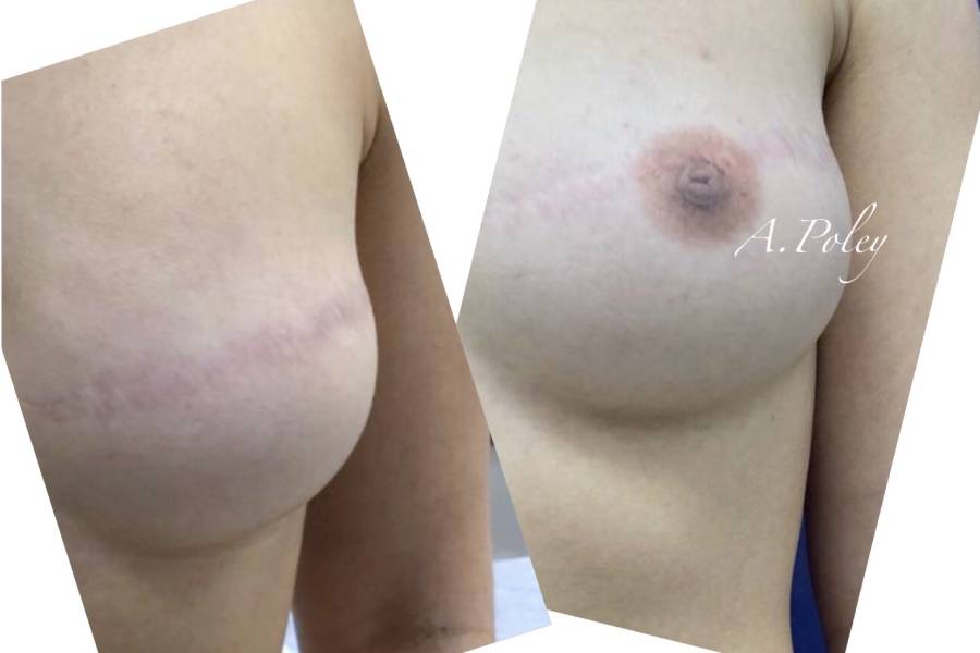 Новая грудь: как восстанавливают красоту молочной железы после мастэктомии